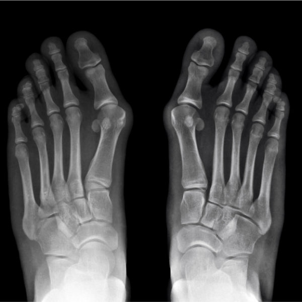 Behind the design: Our unique features for Bunion sufferers