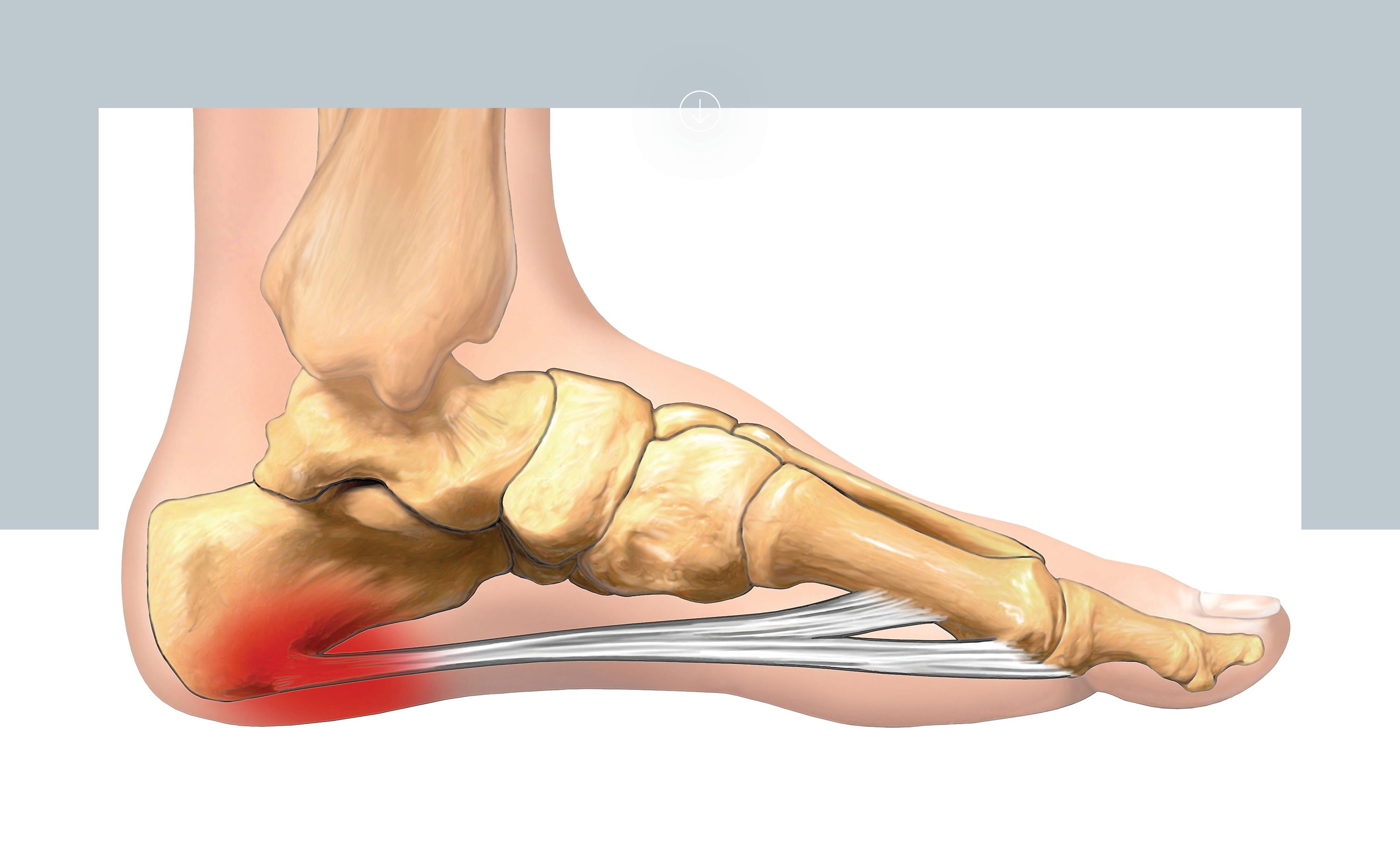 Behind the design: How we help resolve Heel Pain - Part 1